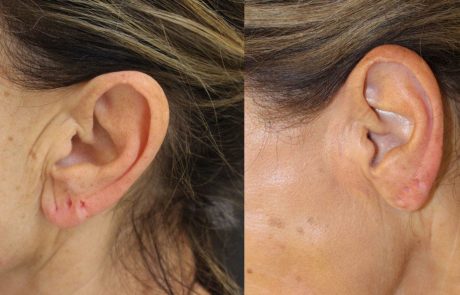 Plexr plasmaexerese plasmajet oreilles