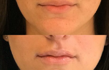 Traitement acide hyaluronique lèvres